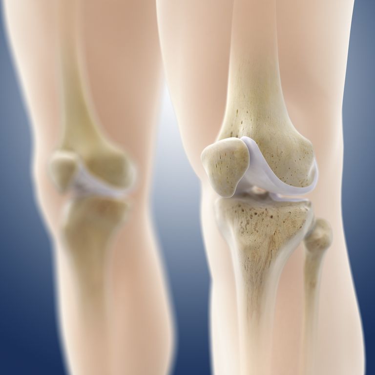 Osteocondritis Disecante de la rodilla