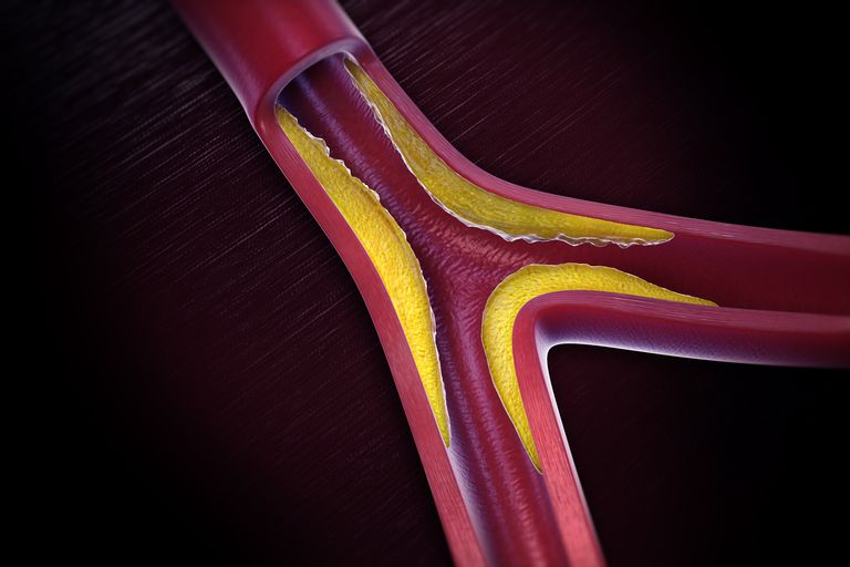 Visión general de la enfermedad de las arterias periféricas
