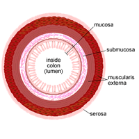 Descripción general de la etapa 1 Cáncer de colon