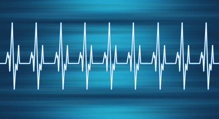 Descripción general de las taquicardias y los ritmos cardíacos rápidos