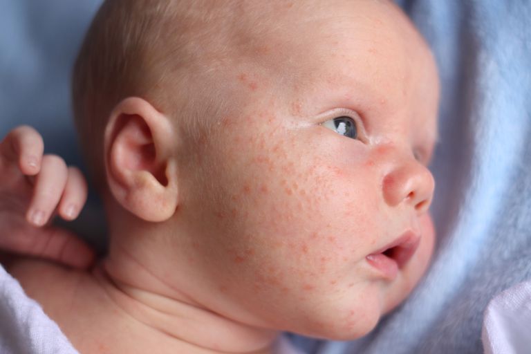 Una guía para padres sobre el acné infantil (acné del bebé)