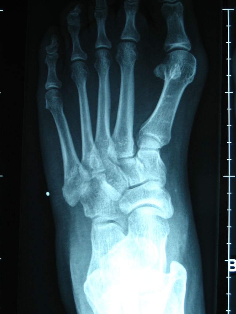 Fotos y rayos X de las deformidades del juanete / HAV