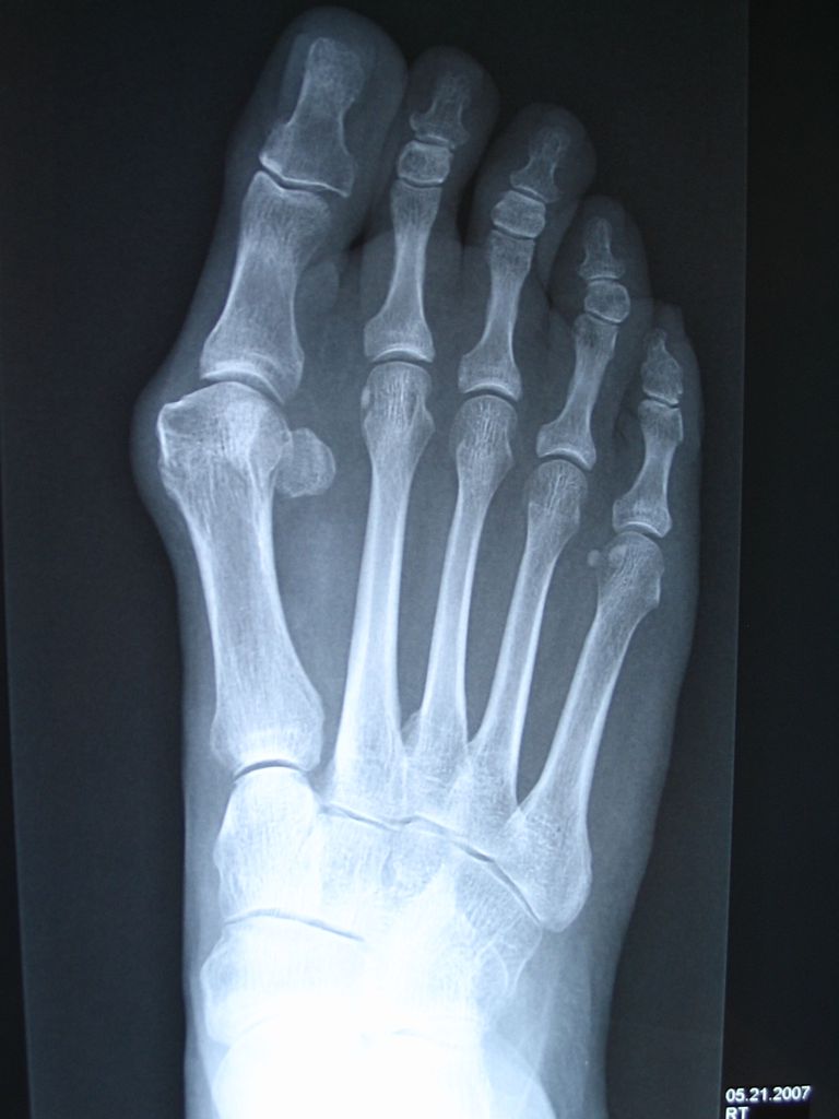 Fotos y rayos X de las deformidades del juanete / HAV