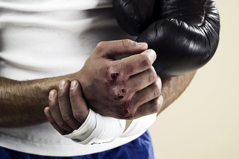 Terapia física después de una fractura de boxeador