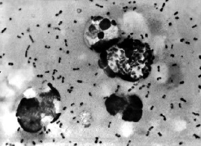Imágenes de la peste bubónica