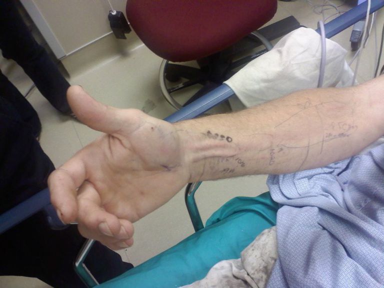 Imágenes de una mordedura de serpiente de cascabel en el hospital