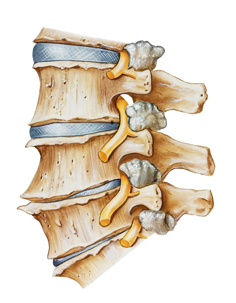 Síntomas del nervio pellizcado en el cuello o en la espalda