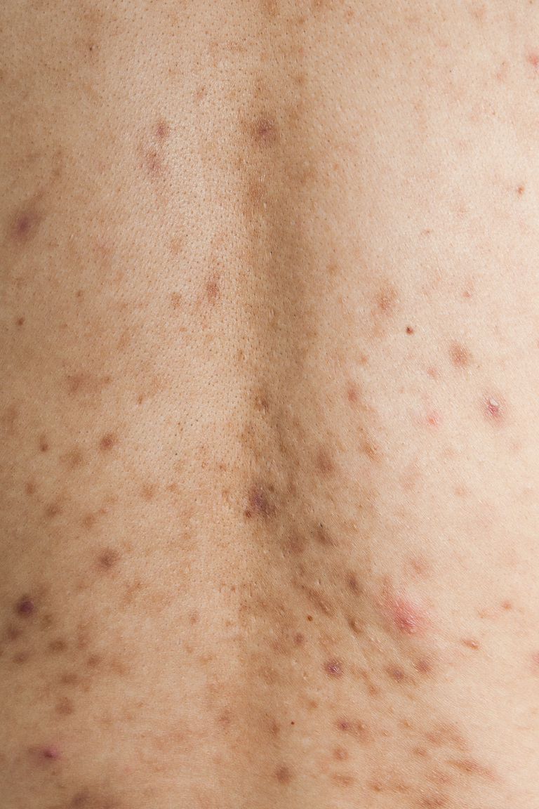 Hiperpigmentación post-inflamatoria y la hiperpigmentación de la piel del acné