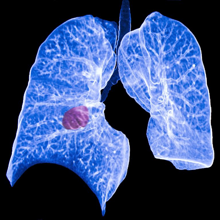 Cáncer de pulmón primario y secundario
