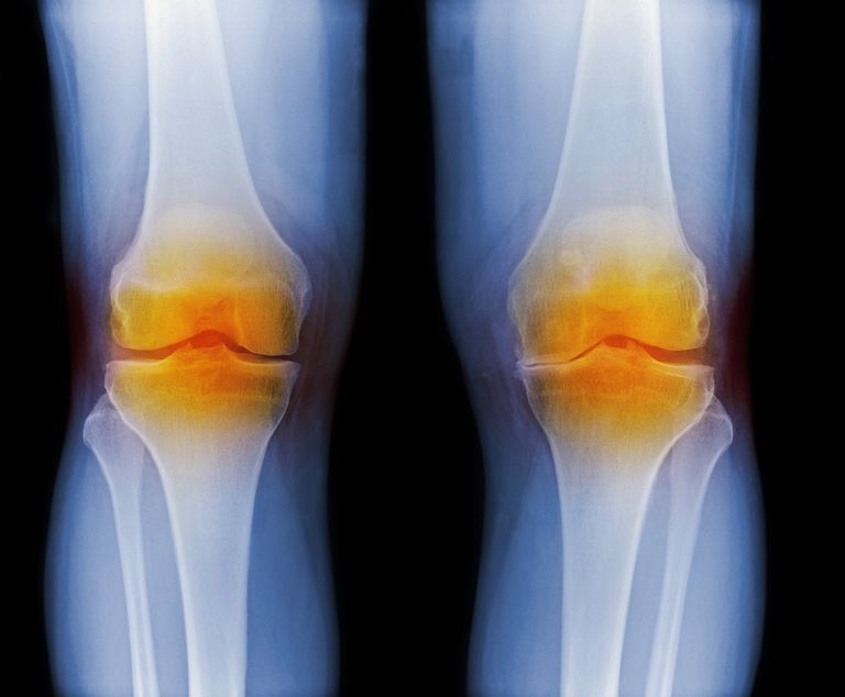 Daño articular progresivo en la artritis reumatoide