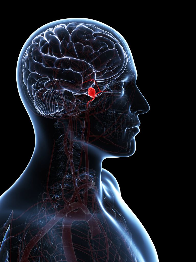 Reconocimiento y reacción a aneurismas cerebrales