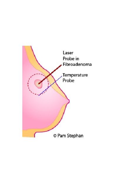 Extracción de un fibroadenoma con terapia con láser