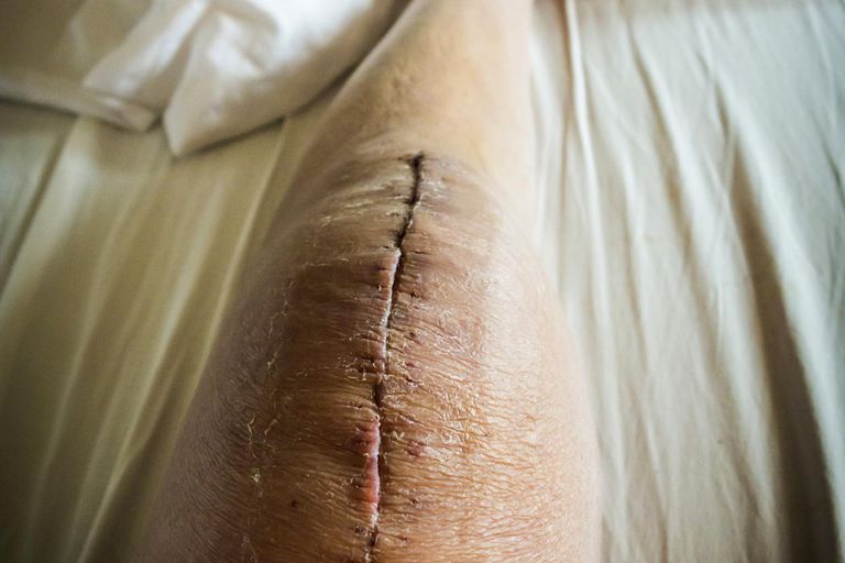 Cicatrices después de la cirugía