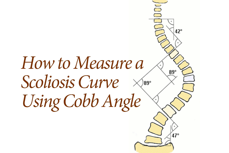 La escoliosis se mide por el ángulo de Cobb