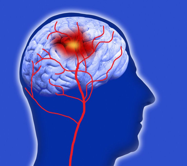 Detección y prevención del accidente cerebrovascular en la anemia falciforme