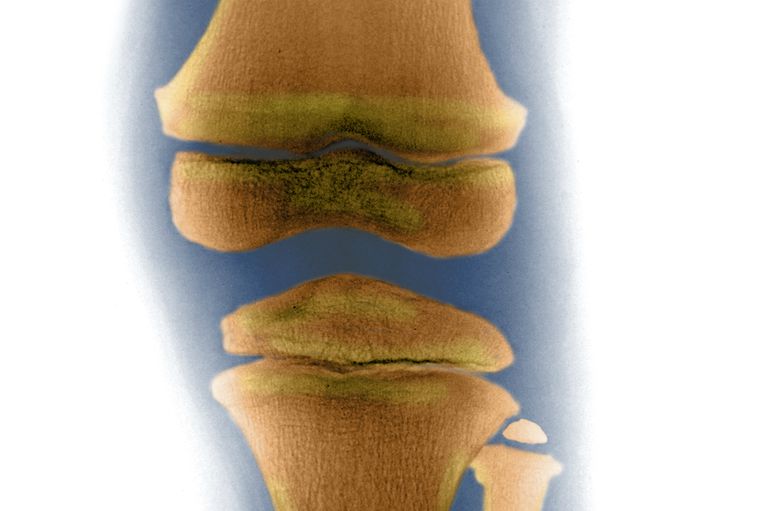 La importancia del hueso subcondral en la osteoartritis