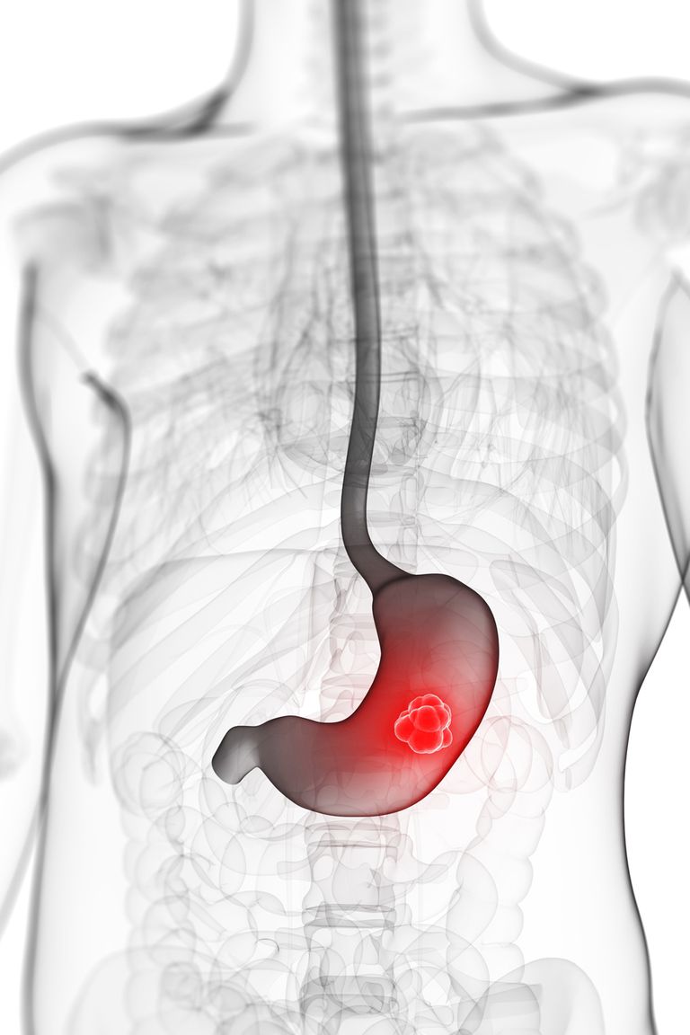 Las etapas del cáncer de estómago