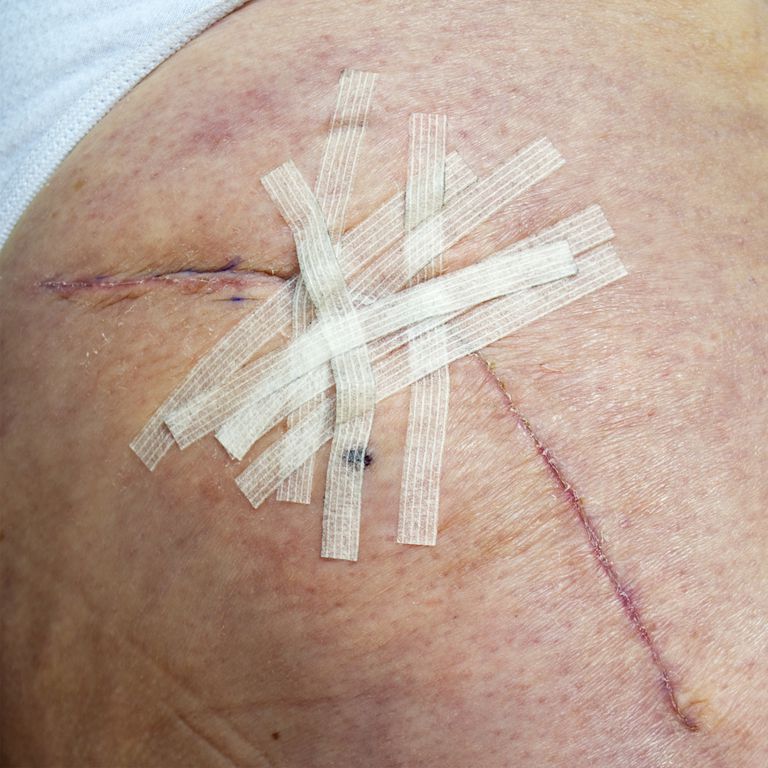 Steri-Strips-Cómo quitarlos de forma segura después de la cirugía