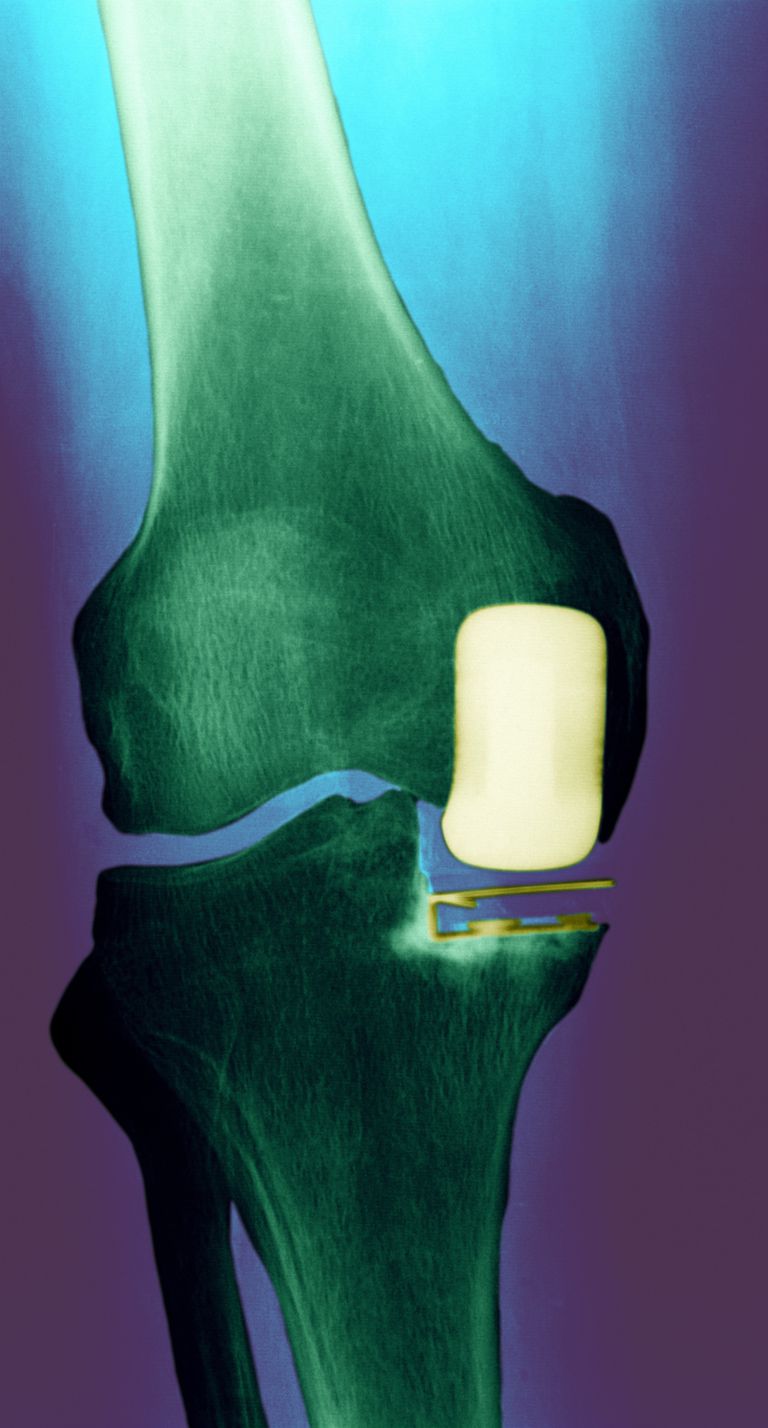 Tratamientos de cirugía para el dolor y las lesiones en la rodilla