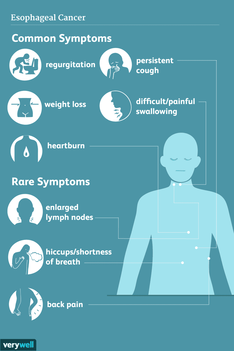 Síntomas del cáncer de esófago