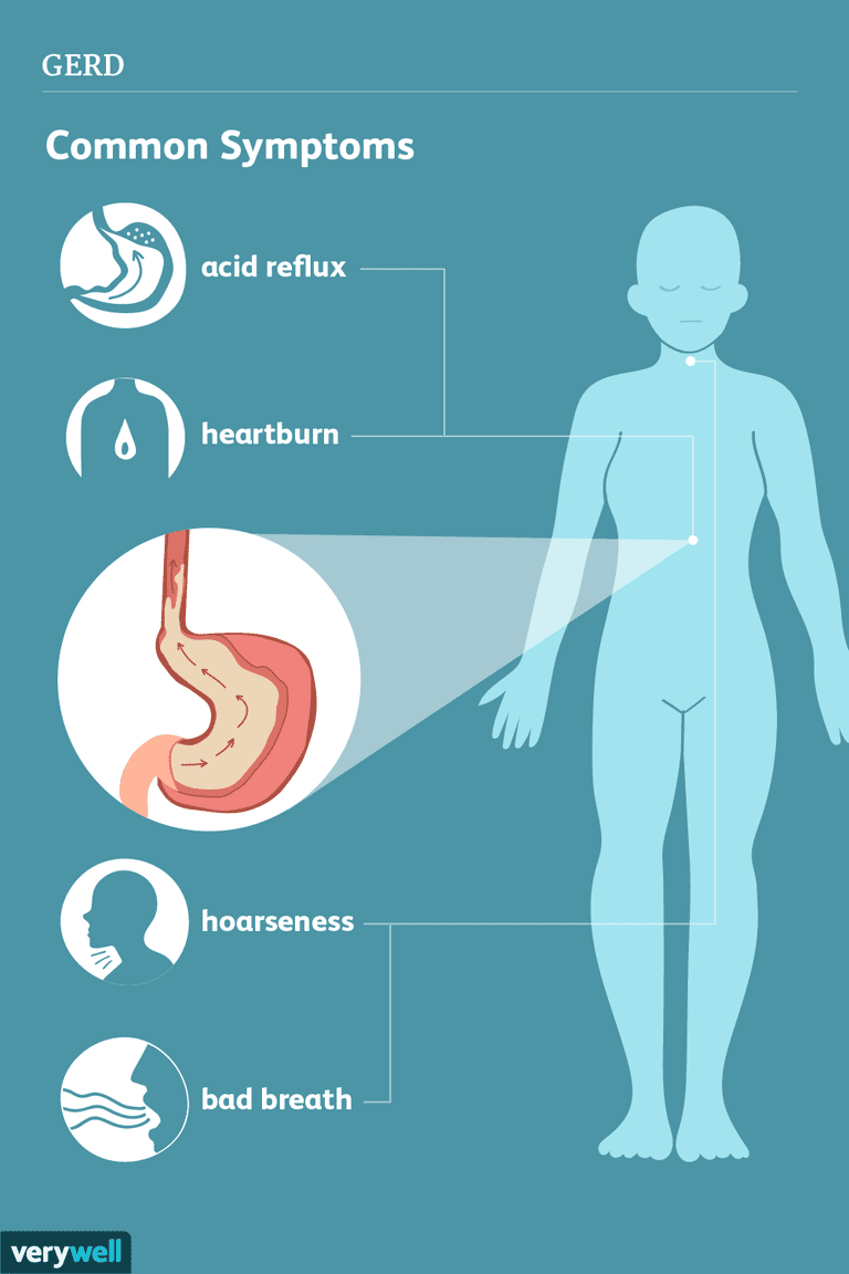 Síntomas de la enfermedad por reflujo gastroesofágico (ERGE)