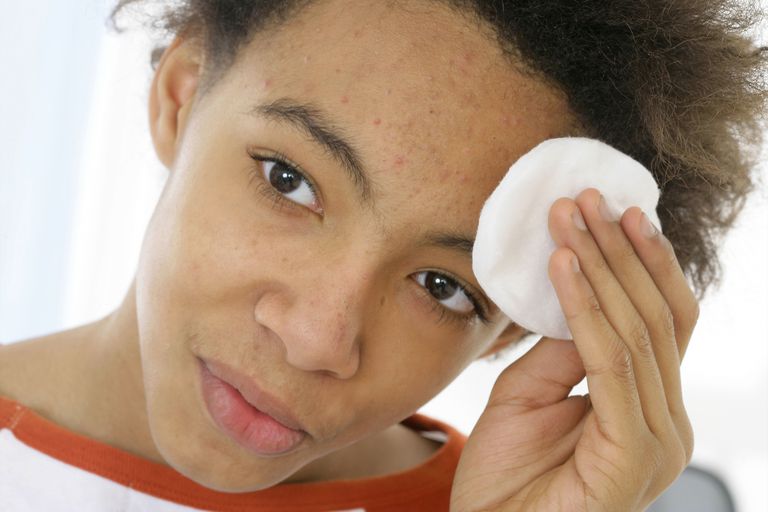 Consejos para tratar el acné y la piel grasa