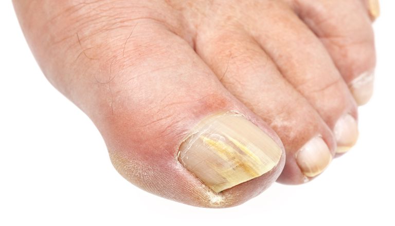 Tratamientos tópicos para los hongos en las uñas de los pies