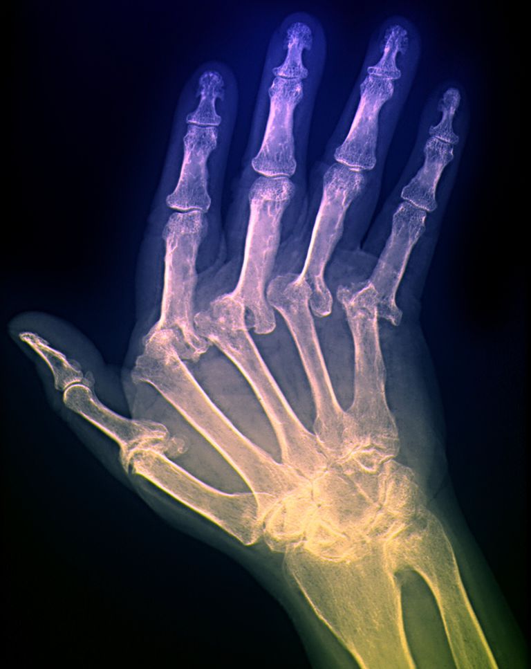 Artritis dr Deriva cubital, también conocida como desviación cubital, es una deformidad de los dedos de la mano. Específicamente, la deriva cubital ocurre cuando hay desviación cubital y subluxación volar de las articulaciones metacarpofalángicas (MCP). Anatómicamente, las falanges proximales se unen con los metacarpianos de la mano en las articulaciones metacarpofalángicas. Las articulaciones MCP se conocen más comúnmente como nudillos. Sub La subluxación volar de la articulación metacarpofalángica se desarrolla cuando hay una dislocación parcial de la articulación, la falange proximal se desplaza alejándose de la cabeza metacarpiana, moviéndose en la dirección palmar. Las falanges intermedias y distales siguen el movimiento cambiante de la falange proximal.