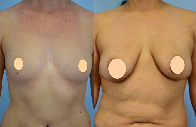 Una guía paso a paso para saber si necesita un levantamiento de senos