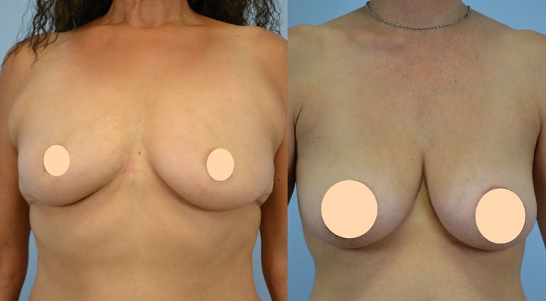Una guía paso a paso para saber si necesita un levantamiento de senos