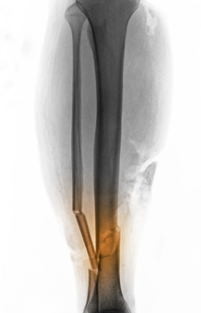 Comprensión de radiografías de fracturas óseas
