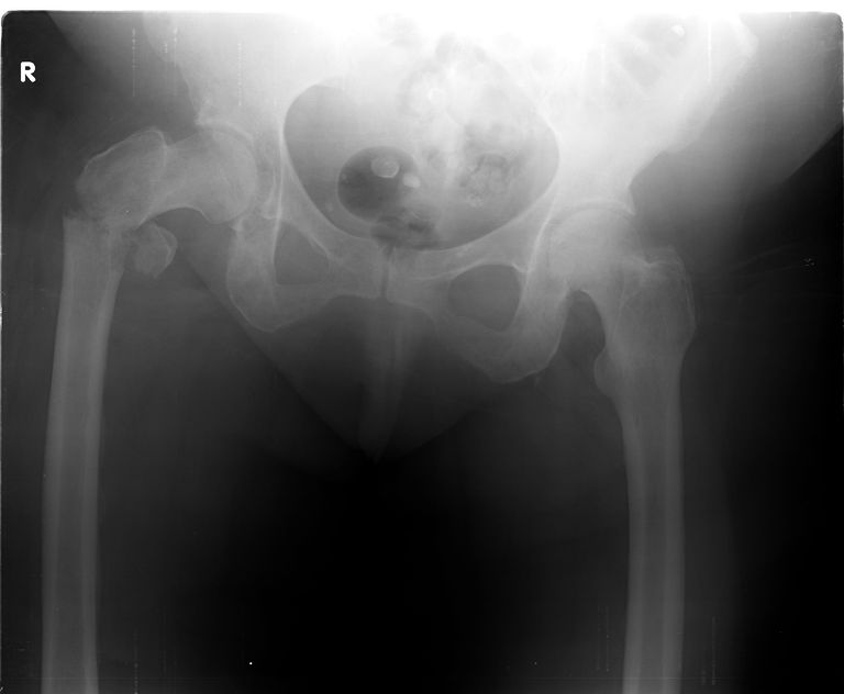 Comprensión de radiografías de fracturas óseas
