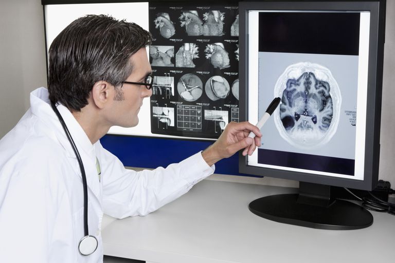 Comprender las lesiones cerebrales relacionadas con la migraña en su MRI