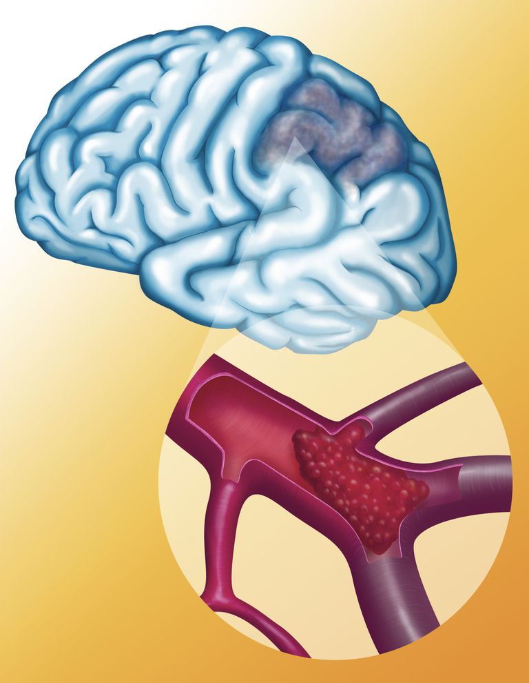 ¿Cuáles son las causas de los accidentes cerebrovasculares?