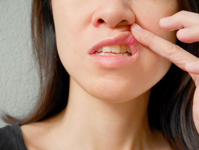 ¿Cuáles son los diferentes tipos de úlceras bucales?
