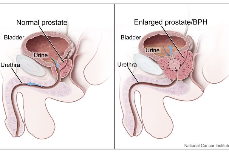 ¿Cuáles son algunos problemas comunes de próstata?