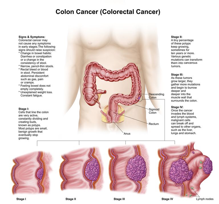¿Cuáles son las etapas del cáncer de colon y recto?