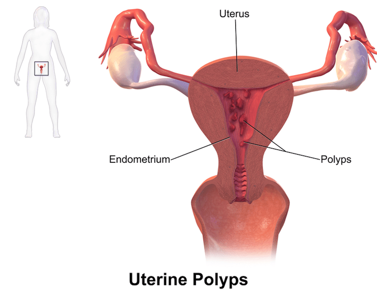 ¿Cuáles son los síntomas de pólipos uterinos?