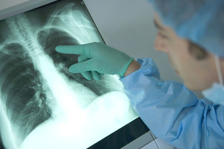 ¿Qué significa tener un nódulo en el pulmón?