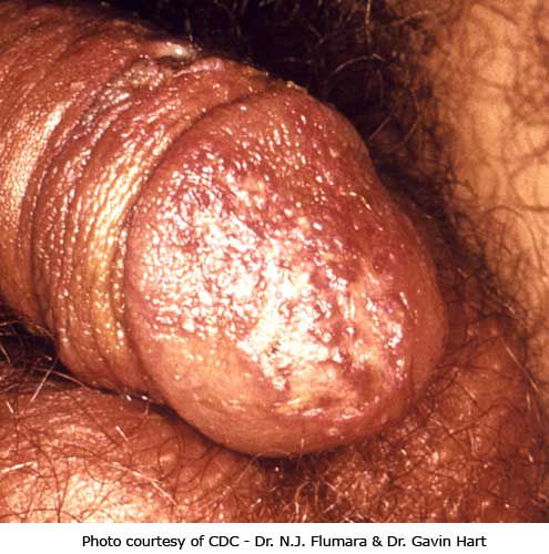 ¿Qué aspecto tiene una erupción de herpes?