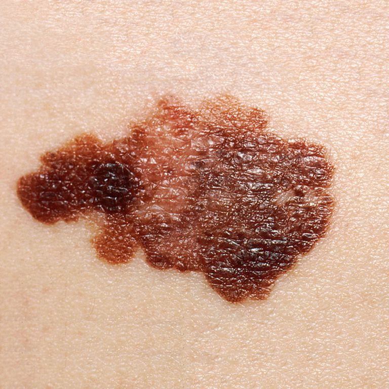 ¿Cómo es el cáncer de piel?