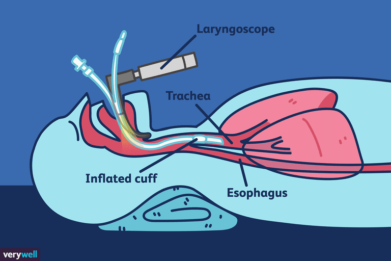¿Qué es la intubación y por qué se hace?
