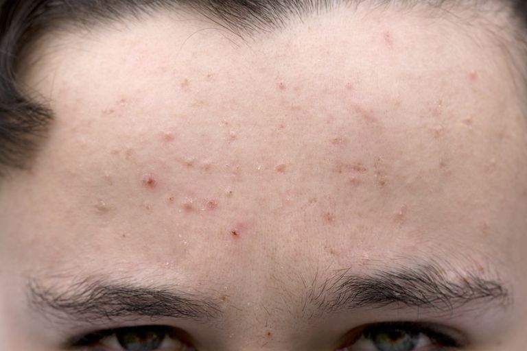 ¿Qué es el acné moderado?