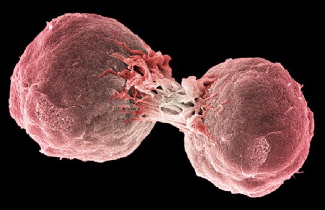¿Qué es el linfoma nodal de células B de zona marginal?