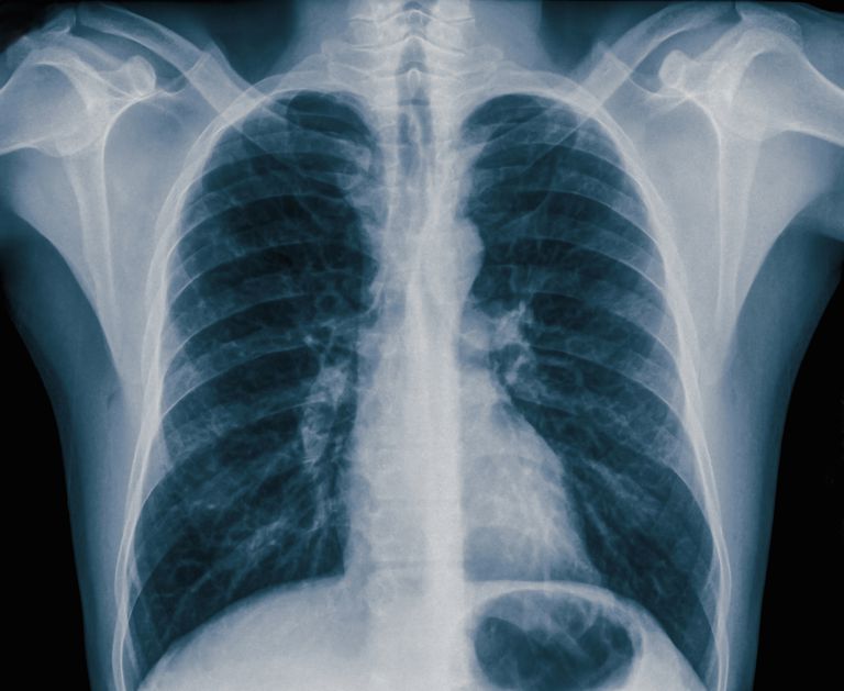 ¿Qué es el neumotórax en los pulmones?