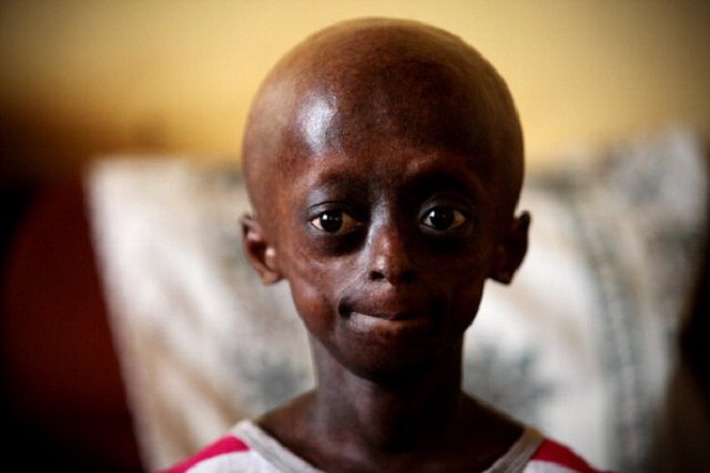 ¿Qué es la progeria?