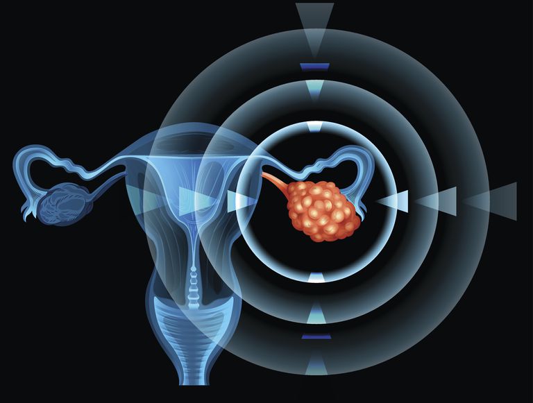 ¿Qué pruebas evalúan una masa ovárica para el cáncer?