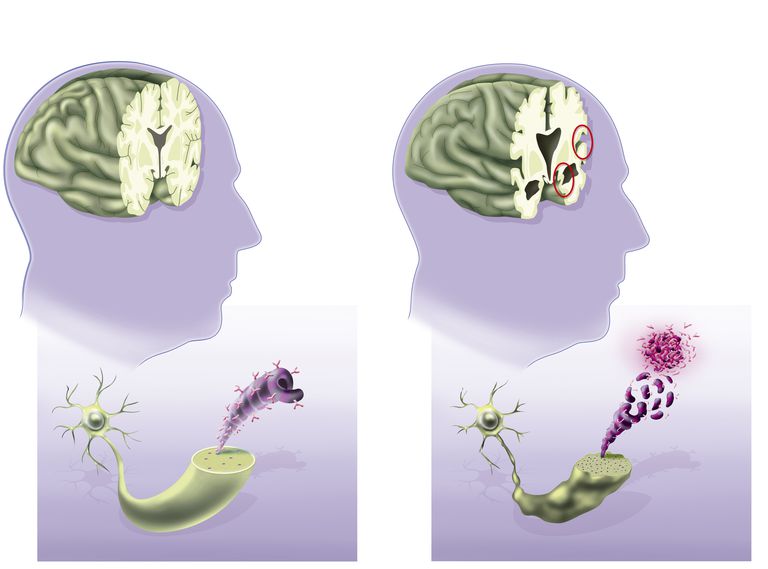 Qué esperar en las últimas etapas de la enfermedad de Alzheimer
