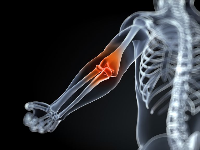 Lo que necesita saber sobre la artritis inflamatoria