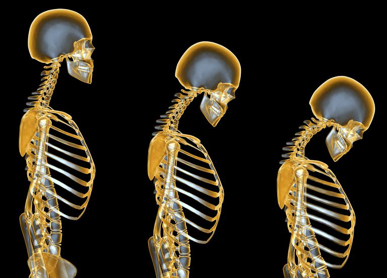 Lo que debe saber sobre la osteoporosis inducida por esteroides